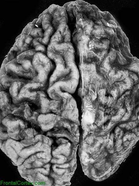 Sneddon Syndrome, dorsal view of brain.